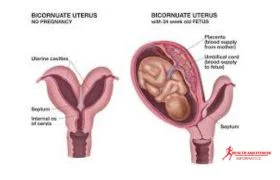 The bicornuate uterus : How does it affect your pregnancy