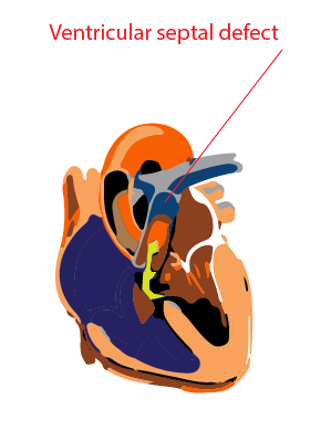 Ventricular septal defect