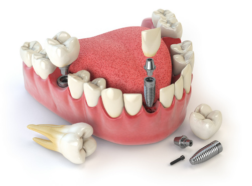  Dental Implant