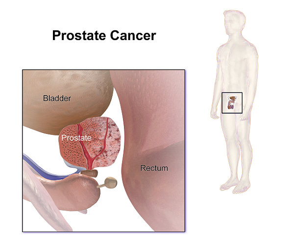 καρκινος του προστατη και πρωιμα συμπτωματα,συμπτωματα καρκινου προστατη