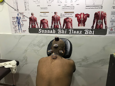 Hijama Cupping For Insomnia