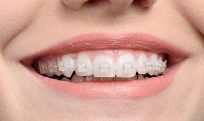 Cách nào chỉnh răng mọc lệch vào trong hiệu quả?-1