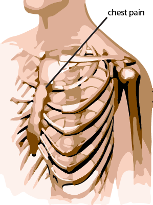 precordial catch syndrome - Texidor's Twinge