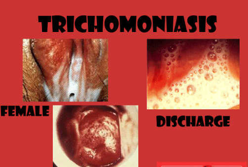 Trikomoniasis