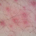 is folliculitis contagious | Pityrosporum folliculitis vs Staphylococcal folliculitis