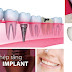 Trồng Implant nha khoa hiệu quả ở đâu?