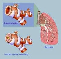 Pengobatan Herbal Bronkitis Kronis