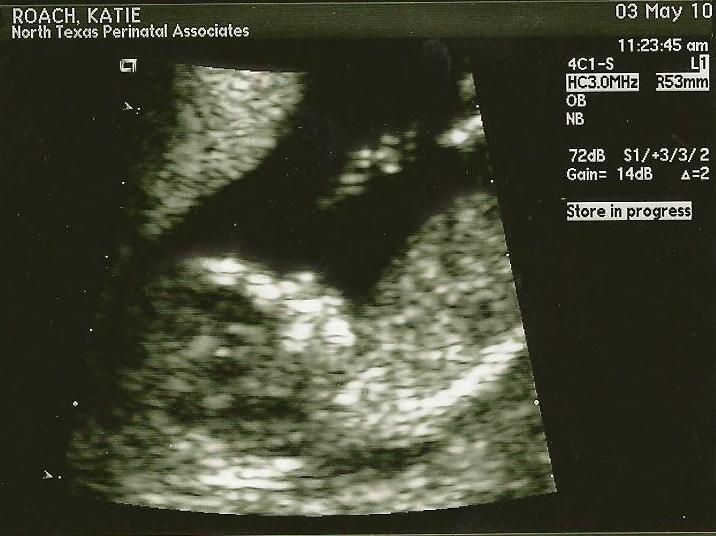 sonogram 5 weeks. Sonogram 5 Weeks.