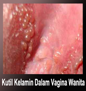 Obat Kutil Mengobati Kutil, Mengatasi Kutil, Menyembuhkan Kutil, Menghilangkan Kutil, Penghilang Kutil, Penghapus Kutil, Perontok Kutil, Obat Kutil Kelamin, Cara & Tips Menghilangkan Kutil 1 Malam Hilang, Menghilangkan Kutil Kelamin Dari Rumah Sendiri Jangka 3 Hari, Obat Kutil Manjur, Obat Kutil Kelamin Pria, Obat Kutil Kelamin Wanita, Obat Kutil Kelamin Untuk Zakar / Ubat Ketuat Di Kemaluan Kelamin Penis Pria, Obat Kutil Kelamin Laki-Laki, Obat Kutil Kelamin Perempuan, Obat Kutil Kelamin Ibu Hamil (Menyusui / Mengandung), Obat Kutil Herbal, Obat Kutil Mujarab, Obat Kutil Alami, Obat Kutil Di Apotek, Obat Kutil Di Dubur / Anus, Obat Kutil Di Paha, Obat Kutil Di Apotik, Obat Kutil Di Dalam / Luar Vagina, Obat Kutil Di Badan Lainnya, Obat Kutil Kelamin Anak-Anak, Krim Kutil,  Obat Kutil Ampuh, Obat Kutil Kelamin Tanpa Operasi Terbukti Keampuhannya, Cream Kutil, Salep Untuk Kutil, Obat Oles Buat Kutil, Obat Penghilang Kutil Pada Kulit Yang Terbukti Aman Tanpa Efek Samping Serta Terpercaya