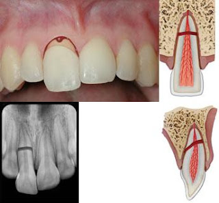 Dentistry lectures for MFDS/MJDF/NBDE/ORE: A Note On Definition