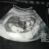Gambar Scan Jantina Bayi Lelaki