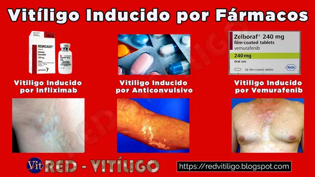 Vitiligo Inducido Por Fármacos