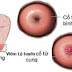 Chữa viêm lộ tuyến cổ tử cung bằng thuốc nam