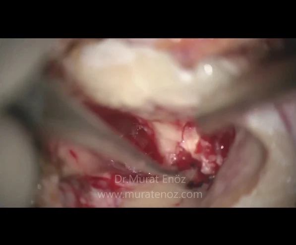 Smelly ear discharge - Malodorous ear discharge - Cholesteatoma - Cholesteatoma treatment - Cholesteatoma Symptoms - Cholesteatoma Definition - Mastoidectomy operation - Ear surgery in Istanbul - Ear surgery in Turkey