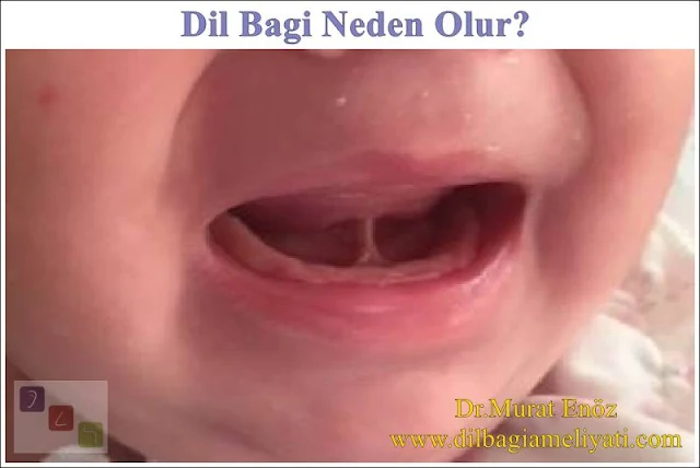 Dil Bağı Neden Olur?