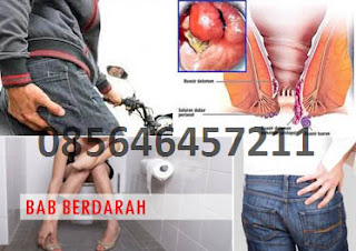 Obat Wasir, Hemoroid dan Anal Abses