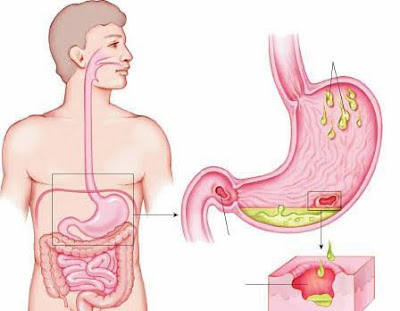 Stomach ulcer treatment health care