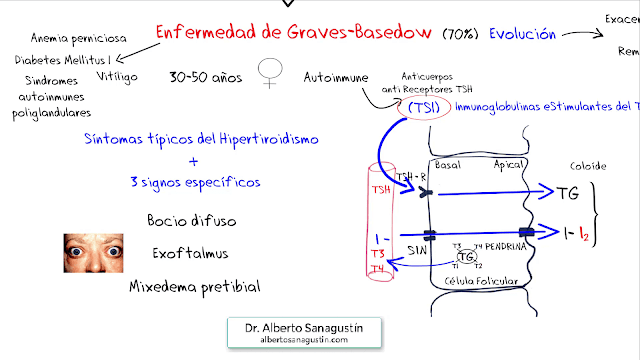 enfermedad de Graves Basedow