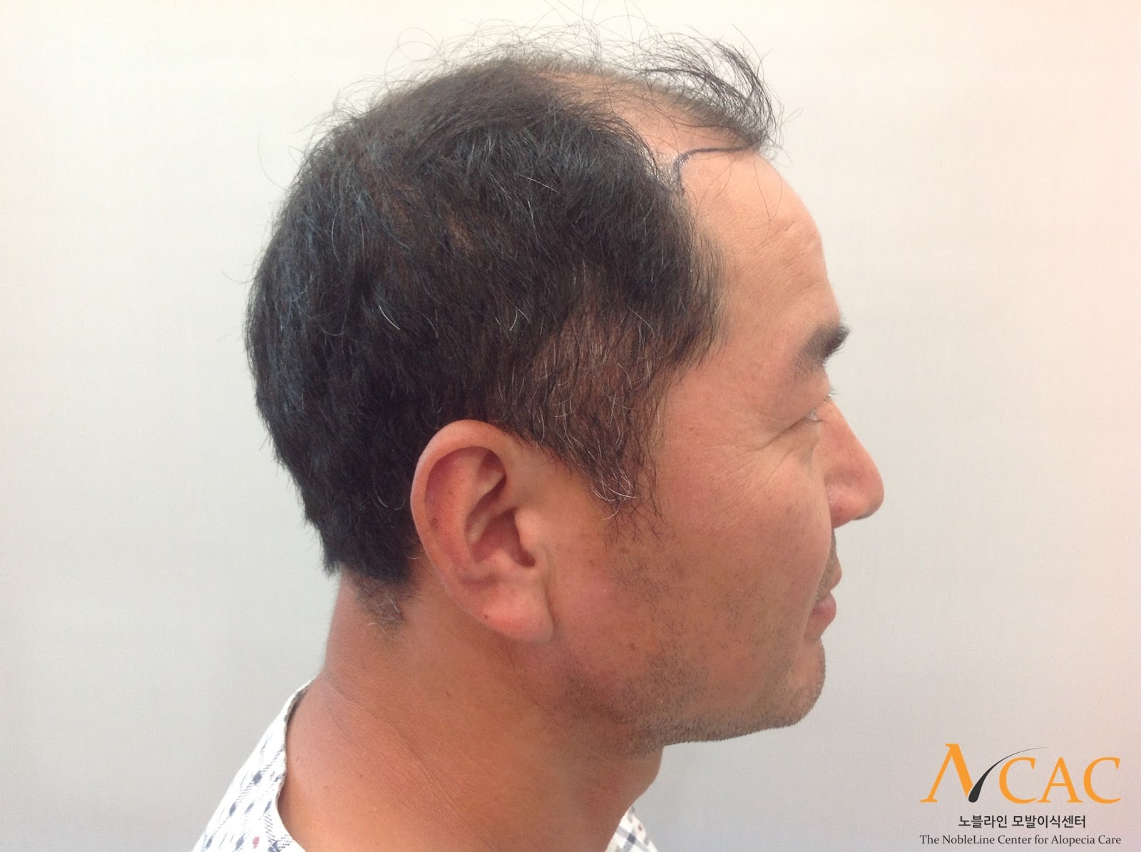 4500 Grafts Result FUE Hair Transplant After 1 Year ...