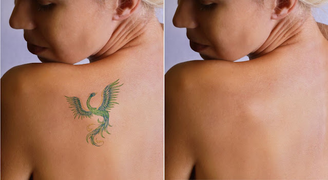 home remedies for tattoo removal