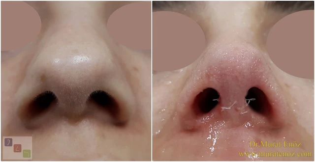 nose tip plasty, alar rim grafts, nasal surgery, tip rhinoplasty, nose reshaping, nasal grafting, cosmetic nose surgery, alar support