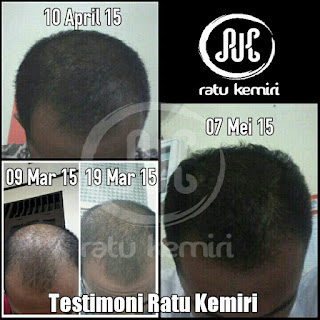 Testimoni minyak kemiri bakar ratu kemiri kebotakan rambut