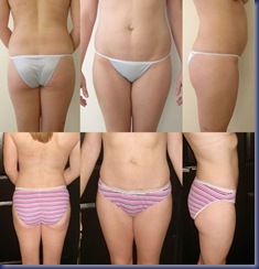 liposuction_4