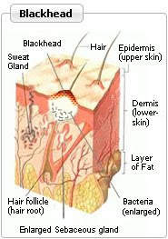 BlackHead