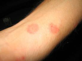 Dangerous Insect Bites However, bed bug bites can