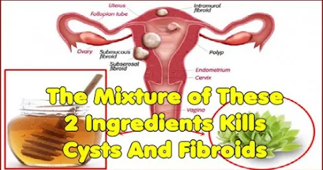 The Best Treatment for Fibroid