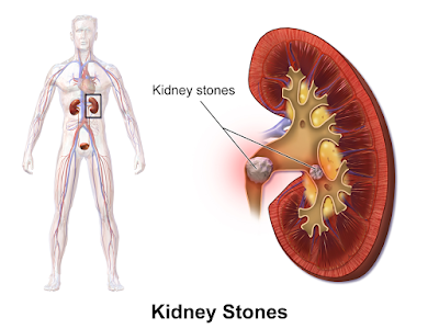  Renal stone, kidney stone, cirrunirakathil kal