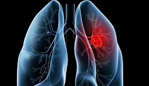 Lung Cancer - Causes, Symptoms and Treatment