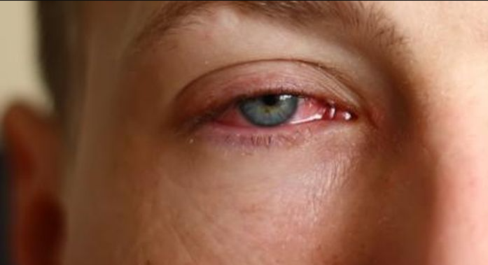 desconforto ocular, hematomas e dormência, até condições graves, como oclusões de veias e artérias retinianas, hemorragia ocular e enxaquecas retinianas e oftálmicas
