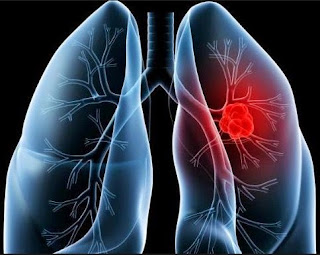 Beware of Lung Disease Symptoms Early