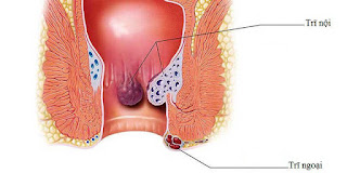 Bệnh trĩ là gì ?