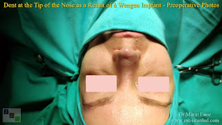 Breathe Implant à Wengen,4. revision nose job, Dent After Rhinoplasty, Complicated 4th Revision Rhinoplasty, Nasal contour irregularities, Postoperative dent issues, Revision rhinoplasty challenges, Rhinoplasty side effects, Nasal structural integrity,