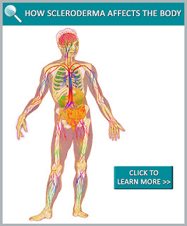  Scleroderma Foundation