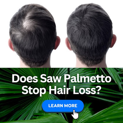 saw palmetto for treating hair loss