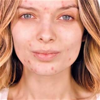 Acne vulgaris, jeugdpuistjes, puistjes, vetpuistjes, pukkels