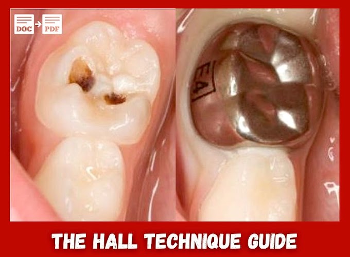 PDF: THE HALL TECHNIQUE GUIDE: A minimal intervention, child centred approach to managing the carious primary molar