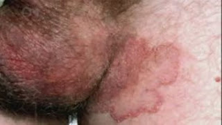 Gambar Penyakit Eksim Di Kaki, mengatasi gatal pada eksim, Eksim Pd Ibu Hamil, Gambar Penyakit gatal eksim Dan Obatnya, Herpes Vs gatal eksim, Eksim Di Wajah Bayi, Elocon Obat gatal eksim, Pengertian gatal eksim Adalah, Obat Eksim Bayi, Jenis Penyakit Kulit gatal eksim Basah, Eksim Tahunan, Eksim Bokong, Obat Untuk gatal eksim Menahun, Cara Mengobati gatal eksim Basah Dan Kering, Mengobati gatal eksim Yang Sudah Parah, Obat Gatal Di Selangkangan Tradisional, Obat Tradisional Untuk Mengobati Eksim Basah, Obat Eksim Basah Secara Alami, Eksim Di Kepala, Pengertian Eksim Adalah, Penyebab Dan Obat Penyakit Eksim, Obat Oles gatal eksim Kering, Gambar gatal eksim Basah Pada Kaki, Pengobatan gatal eksim Herbal, gatal eksim Kering Dan Obatnya, Cara Mengobati Penyakit Eksim Dengan Cara Alami, obat sakit gatal eksim, Nama Obat Eksim Kering 