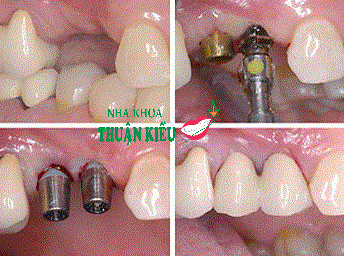 dental-implants-surgery-care