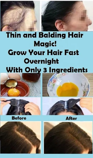 Thin and Balding Hair Magic! Grow Your Hair Fast Overnight With Only 3 Ingredients