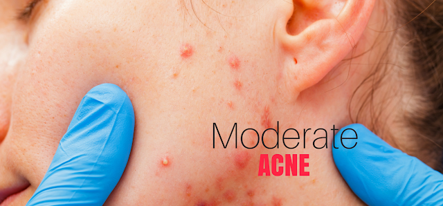 Moderate acne