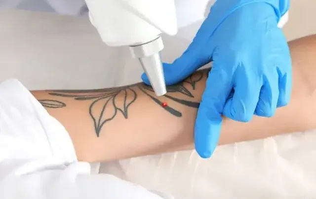Laser tattoo removal on hand