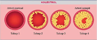 kolestrol tinggi; kolestrol membunuh; bahaya kolestrol; tips turunkan kolestrol; set kolestrol shaklee; Omega shaklee; Phytocol Shaklee