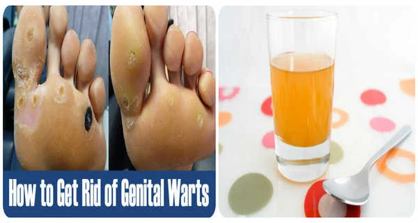 home remedies for genital warts