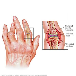 Pharmacotherapy intervention for rheumatoid arthritis (RA) and osteoarthritis (OA)