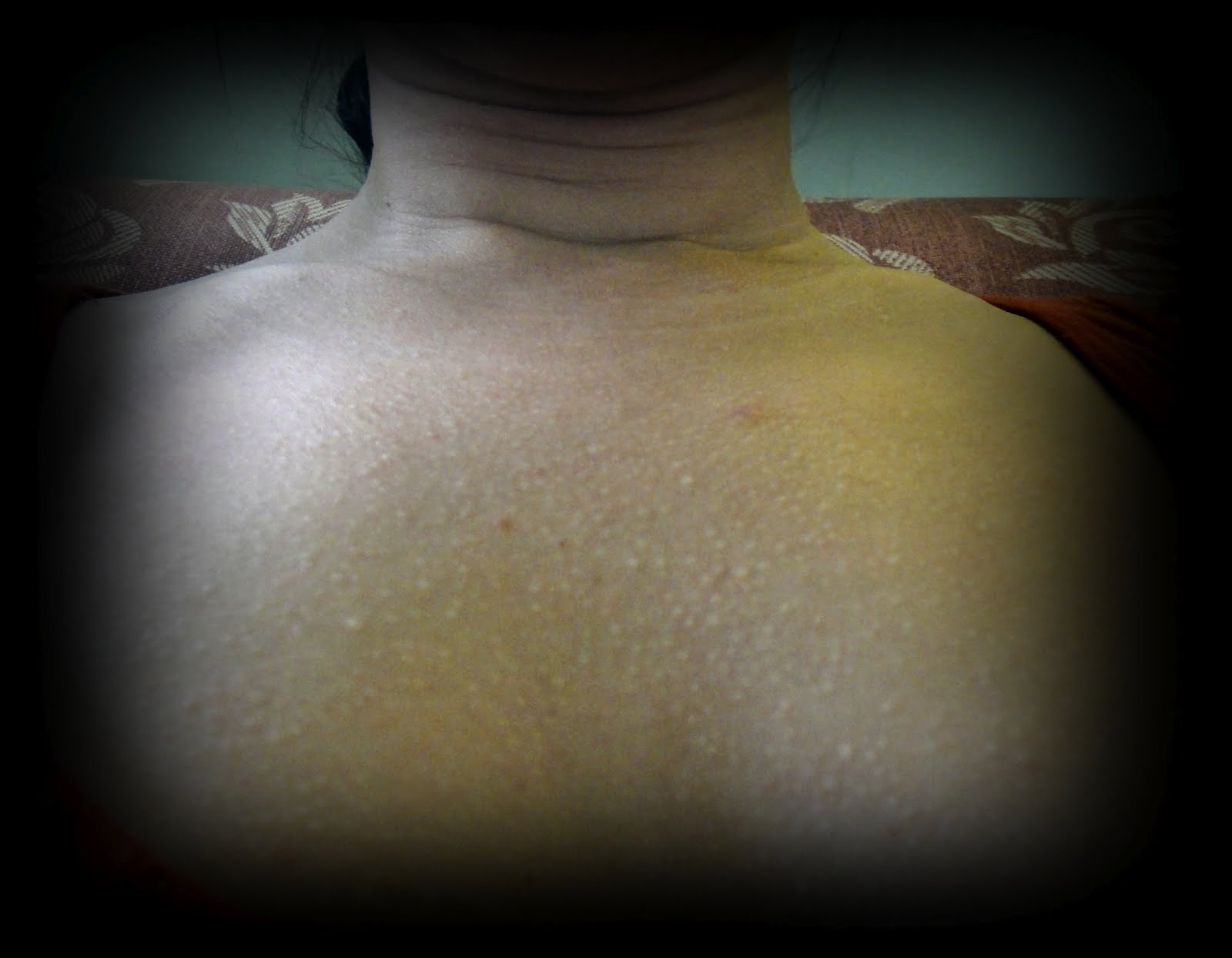 Light Bumps In Chest And Back - Back/Body/Neck acne - Acne.org 