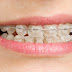 Niềng răng gây hôi miệng khắc phục như thế nào?